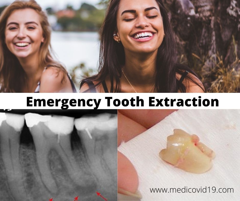 Prepare Yourself for Emergency tooth extraction with these Tips