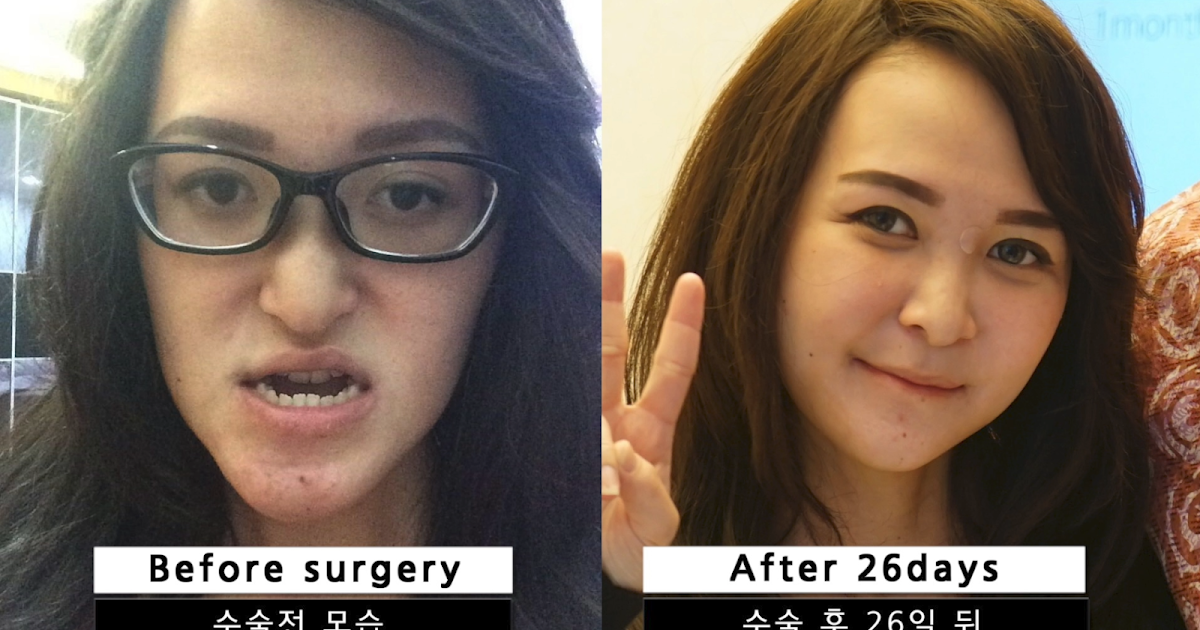 What is a lantern jaw? (Double Jaw Surgery)