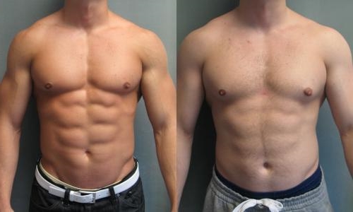 gynecomastia surgery breast male reduction chest therapy enlarged cosmetic plastic operation woman