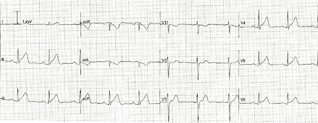 Блог по клинической электрофизиологии: Нижние коронарные зубцы T и ...