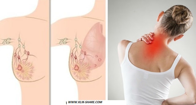 8 gejala kanker wanita sering diabaikan