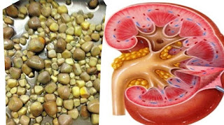 Info Pemesanan Obat Batu Ginjal De Nature Asli Di Pusakanagara Kabupaten Subang