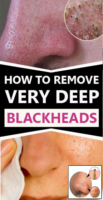 10%2BWays%2BTo%2BGet%2BRid%2BOf%2BDeep%2BBlackheads