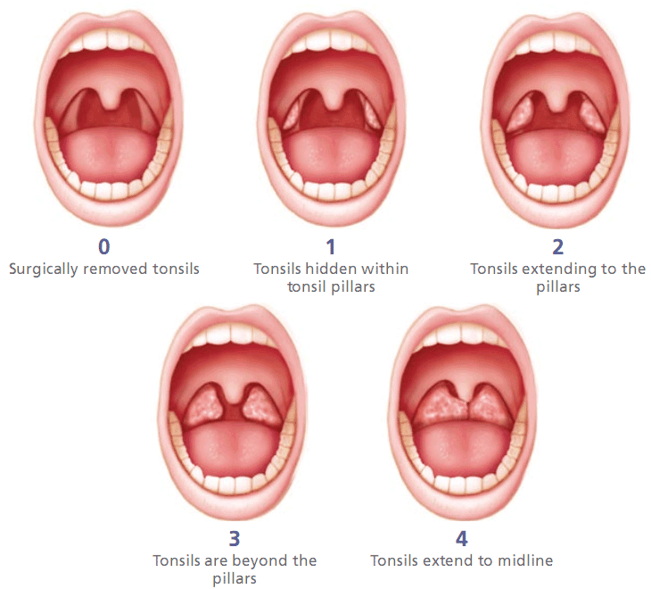 tonsillar hypertrophy score