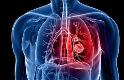 lung cancer