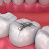 Trám răng duy trì được bao lâu?
