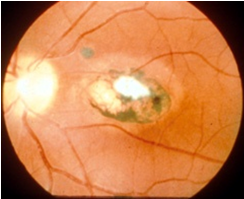 Best treatment option for toxoplasmosis i