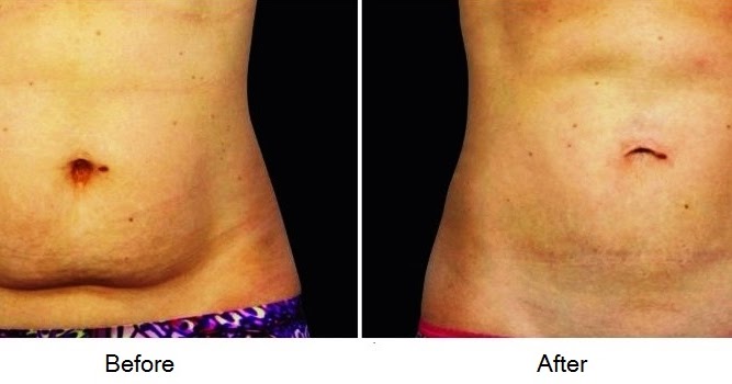 After pregnancy skin care After Pregnancy Skin Care - How should mother take care of her skin