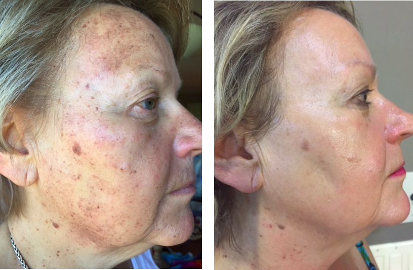 C3 Clinical Corrective Care Sun Damage Sunspots Aging Skin