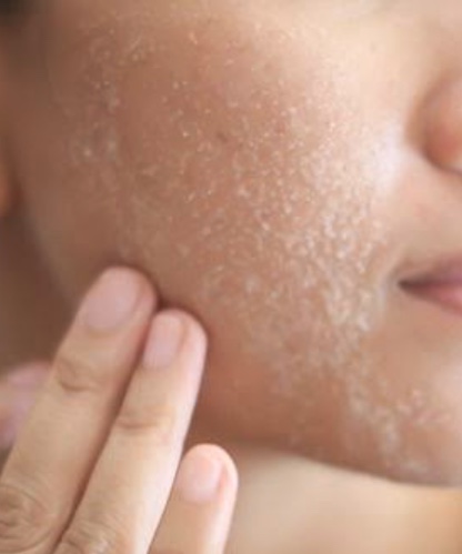 أسباب ظهور القشور البيضاء على الوجه وكيفية التخلص منها
