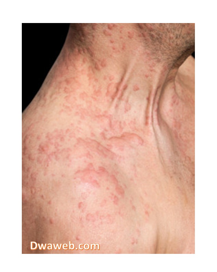 متلازمة الرجل الأحمرRMS) Red man Syndrome) أسبابها وطرق علاجها