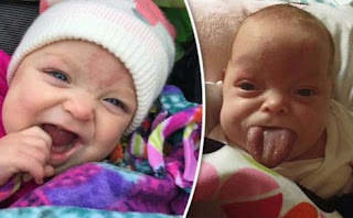 Lidah Bayi Ini DIpotong, Demi Bisa Tersenyum dengan Normal Lidah Bayi Ini DIpotong, Demi Bisa Tersenyum dengan Normal