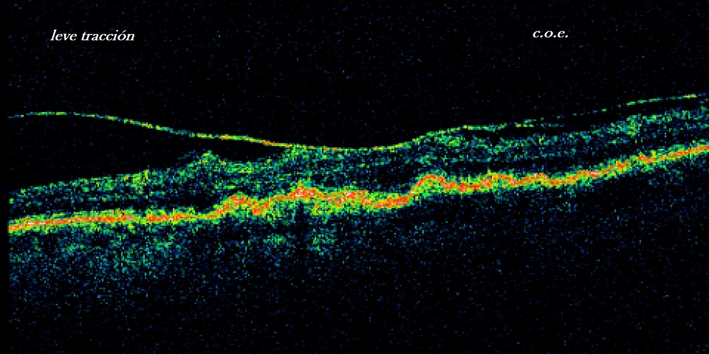 DEGENERACION MACULAR : CONTROL con OCT