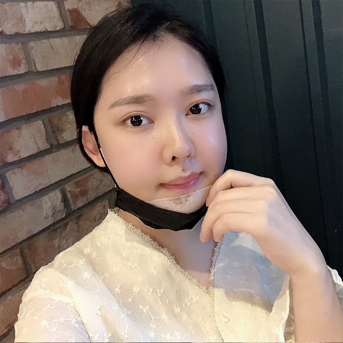 Double Jaw & Vline Surgery Post OP 1 Month