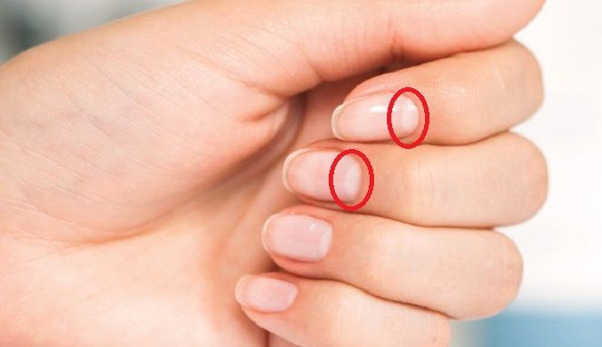 READ MANDATORY Don't Underestimate Sickle in Nails, Number of Sickle Indicates YOUR Health !!!