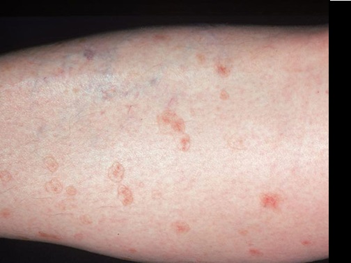 EL RINCÓN DE LA MEDICINA INTERNA POROQUERATOSIS. A PROPÓSITO DE UN CASO