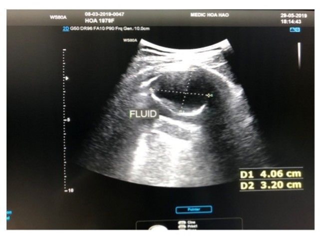 Vietnamese Medic Ultrasound Case 554 Pulmonary Avm Dr Phan Thanh Hai