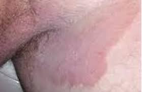 cara mengatasi gatal pada selangkangan dan bokong paling ampuh cara mengatasi gatal pada selangkangan dan bokong paling ampuh