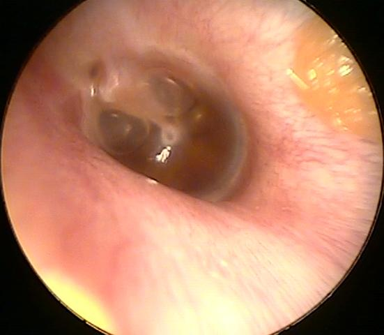 Healthy N Fit Tips To Treat Otitis