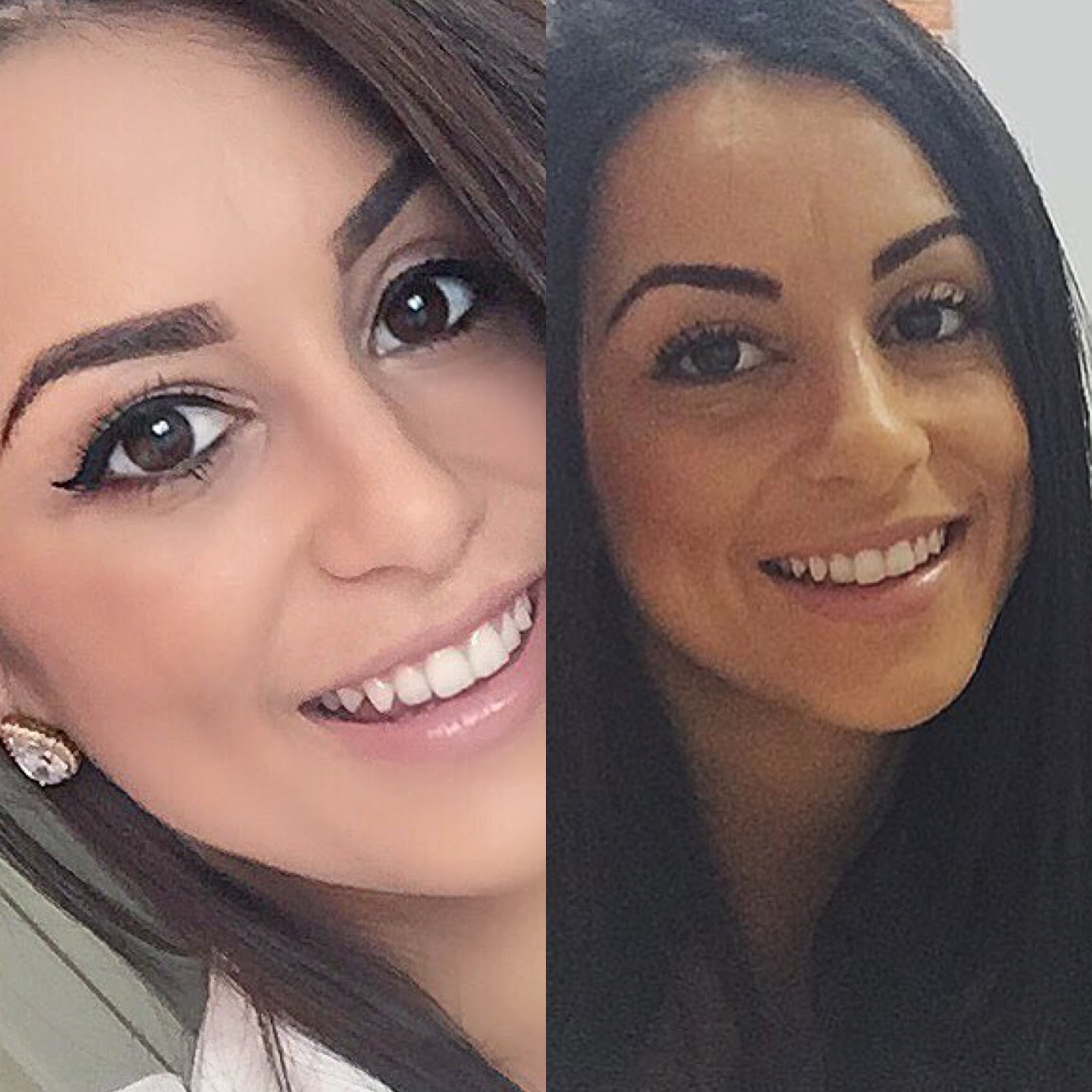 #REVIEW: MEU PREENCHIMENTO FACIAL COM ACIDO HIALURÔNICO - BLOG BAH! GURIA