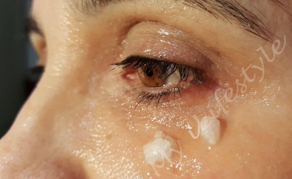 SHE STARTED APPLYING COCONUT OIL AROUND HER EYES. 5 MINUTES LATER