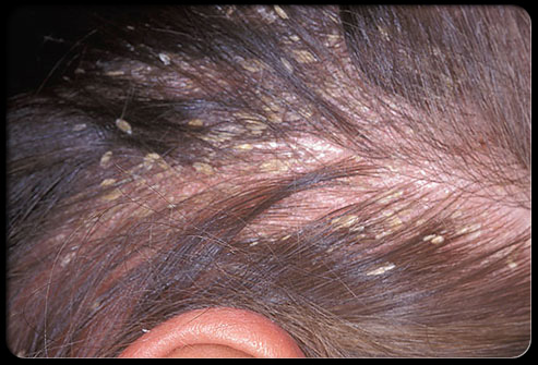 Natural Remedies For Itchy Scalp Black Hair Natural Remedies For Itchy Scalp Black Hair