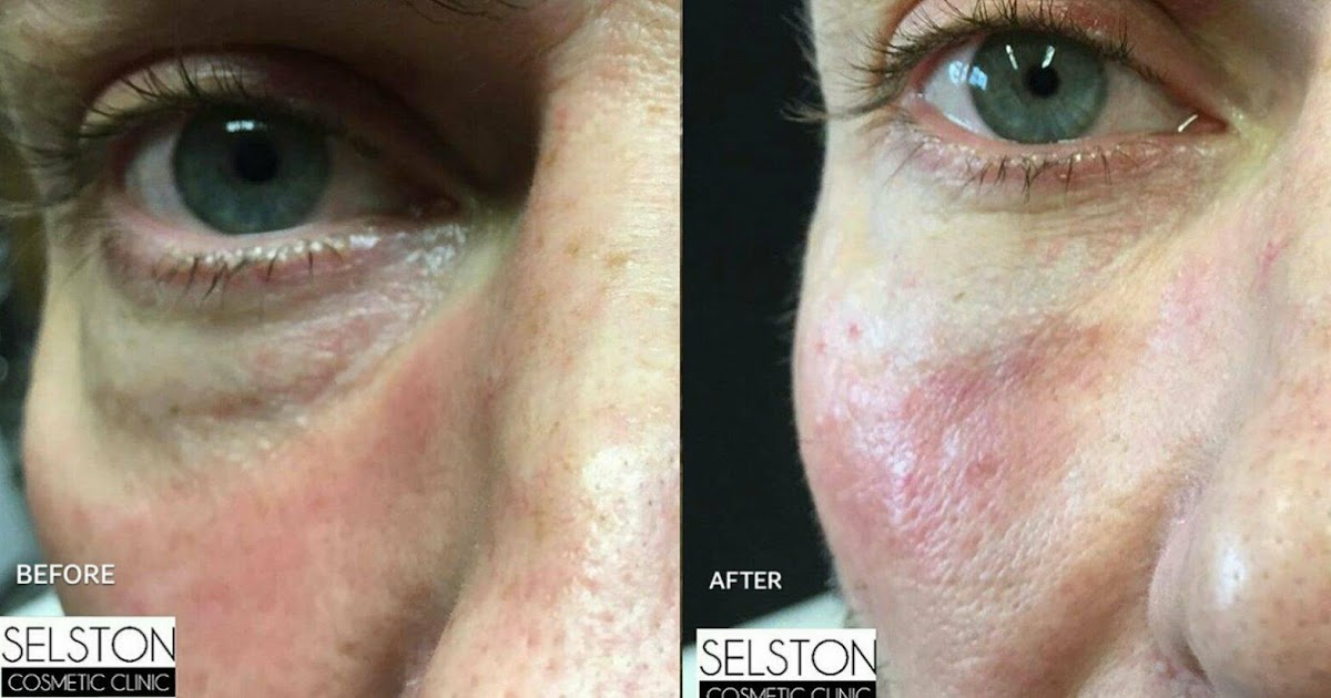 Selston Cosmetic Clinic Correct Eye Hollows & Dark Circles with Dermal