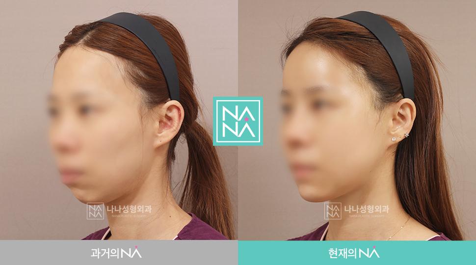 Facial Plastic Surgery AZ! How do I know what is right for me?