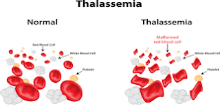 thalassemia-www.healthnote25.com