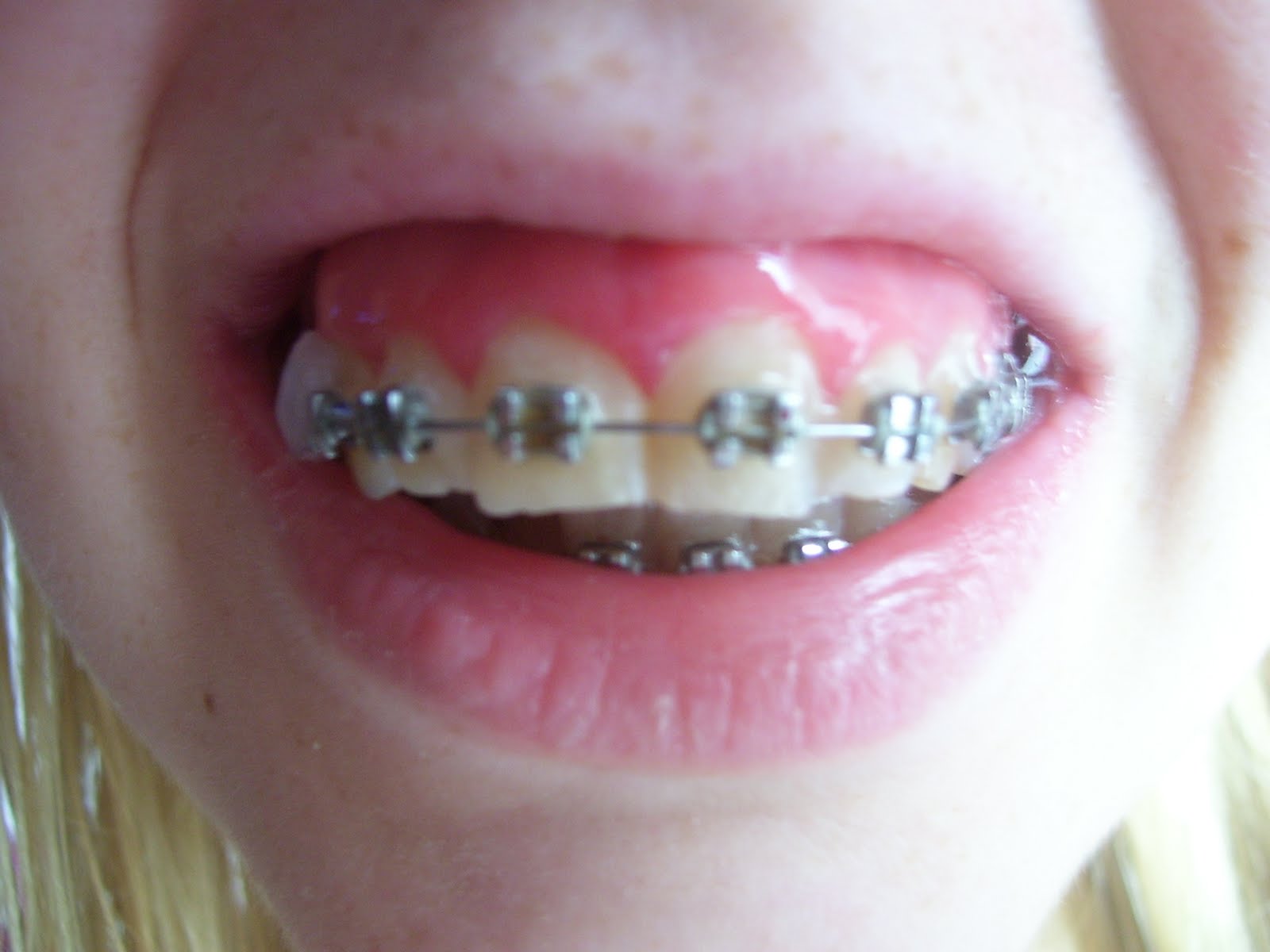 My Jaw Surgery Story 3 months of braces