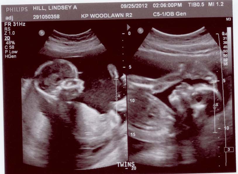 Hill's 24/7 The Anatomy Scan 20 weeks 3 days