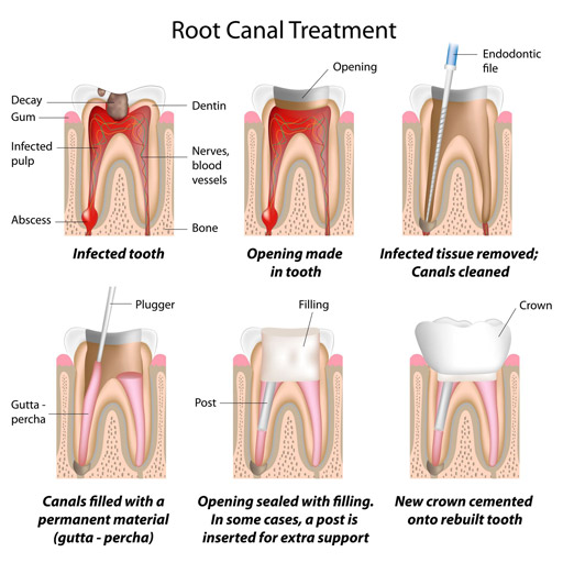 procedure of root canal treatment RCT