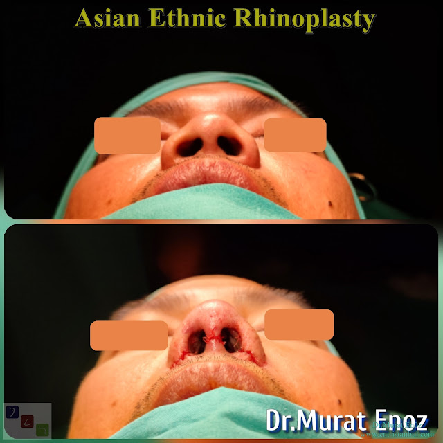 Asian Ethnic Nose Job in Istanbul - Asian Rhinoplasty
