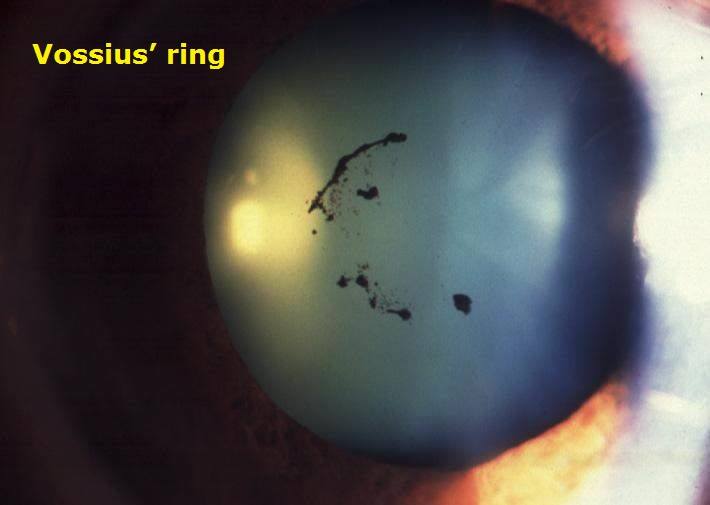 Ophthalmology Notes Rings in ophthalmology