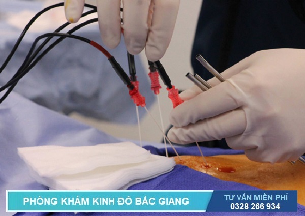 Phương pháp RFA là kỹ thuật điều trị viêm lộ tuyến cổ tử cung hiện đại nhất