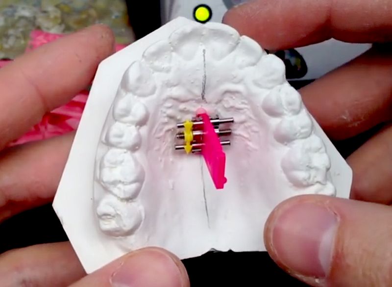 ORTHODONTICS Setting an Expansion Screw in a Retainer OdontoTv