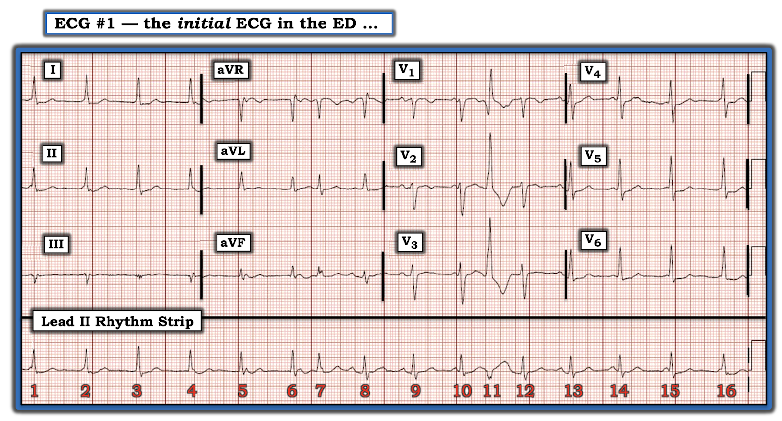 Dr. Smith's ECG Blog Drug Overdose with a Fascinating Arrhythmia