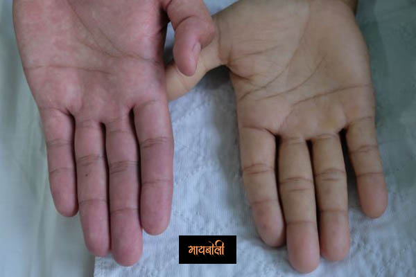 Gomutra Benefits in Marathi Gomutra Benefits in Marathi रक्तातील हिमोग्लोबिन ची पातळी वाढवते