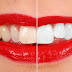 Tẩy trắng răng bằng phương pháp nào hiệu quả?