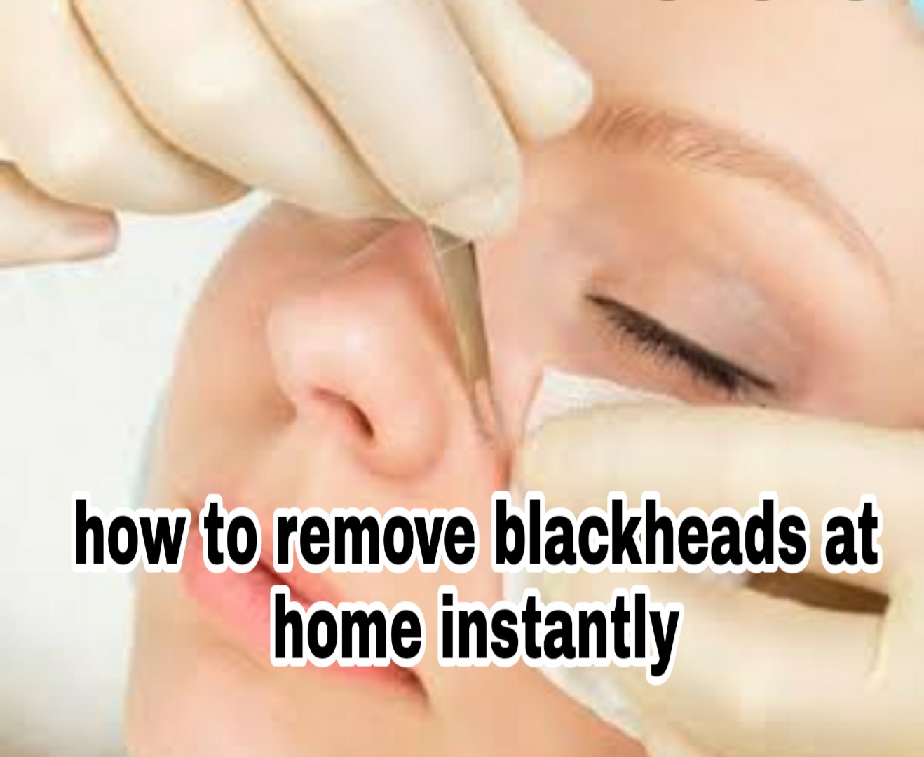 How To Remove Blackheads At Home Instantly Shut Up Vik