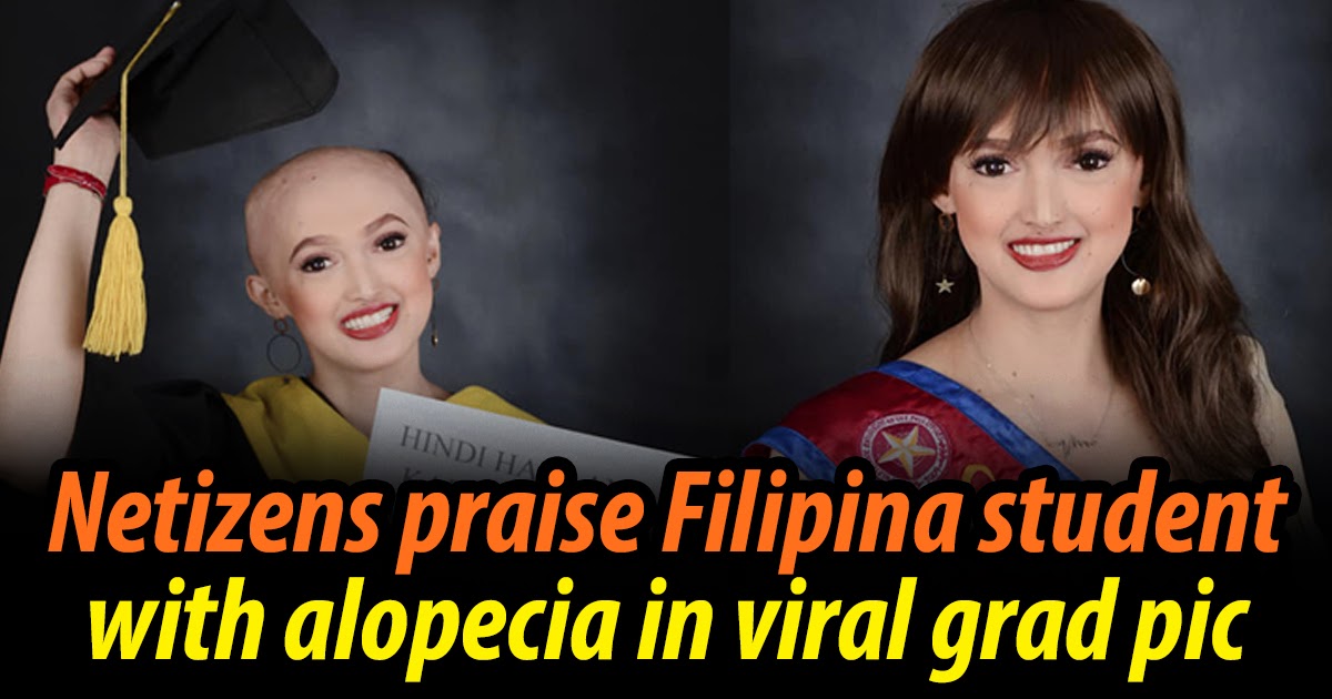 Look Pinay With Alopecia Inspires Netizens With Graduation Photo The