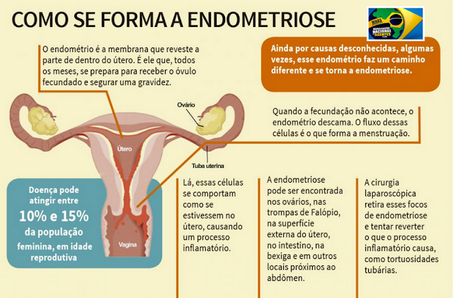 +Março Amarelo – O mês de conscientização da Endometriose - Conexão Notícia
