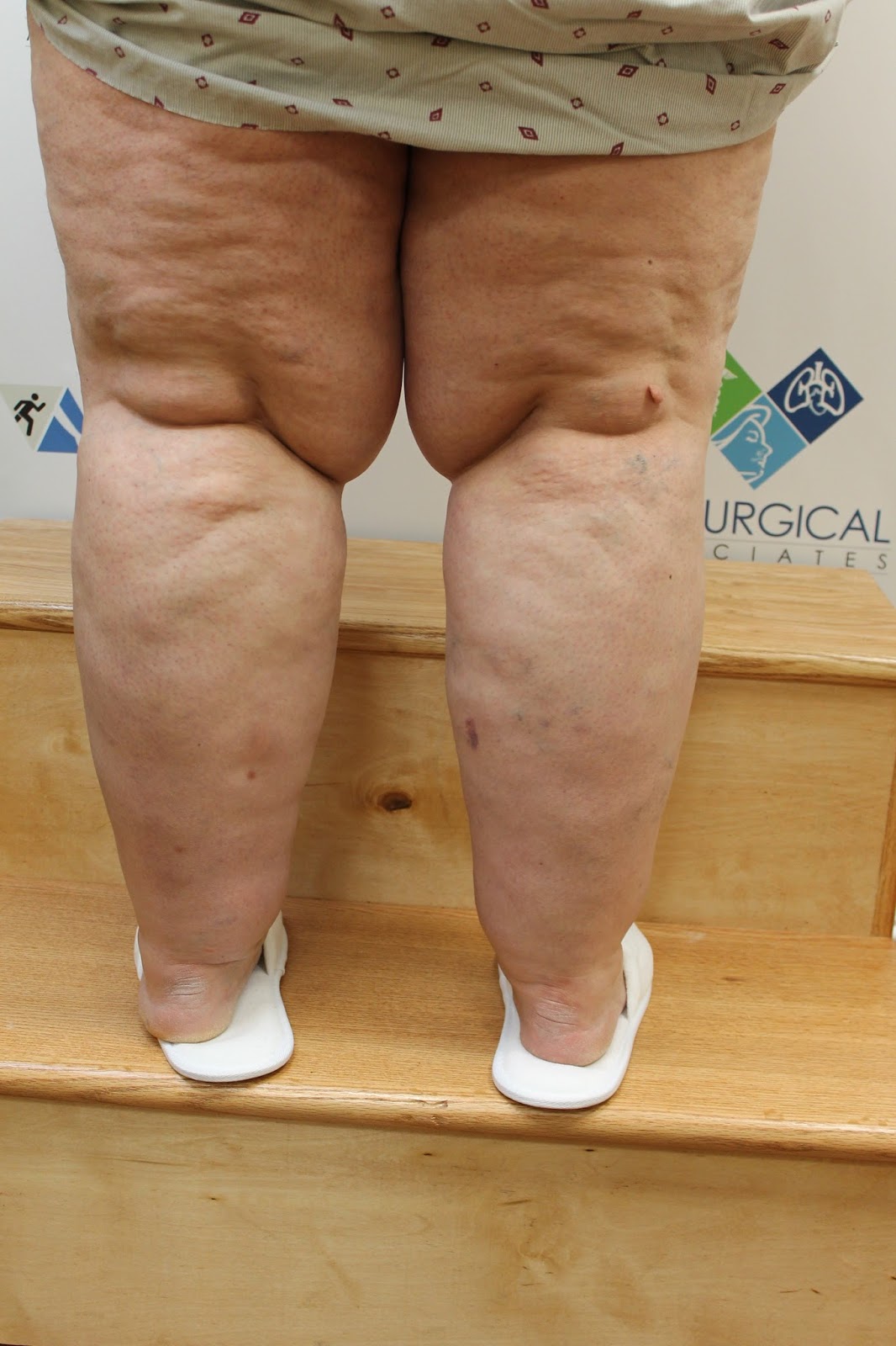 Fat Women Legs 11