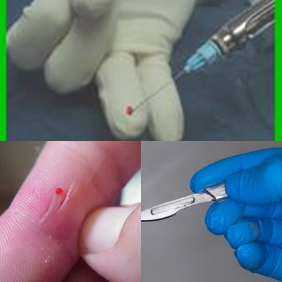 jaitt odonto social: LESIONES PUNZO-CORTANTES EN LA PRÁCTICA ...