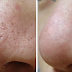 6 Best Home Remedies For Open Pores Treatment
