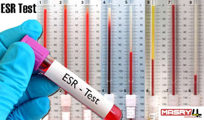 ESR test food that reduce sedimentation rate   اكلات تقلل سرعة الترسيب