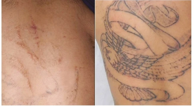 What To Expect From Tattoo Removal
