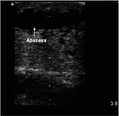 Abscess image on ultrasound