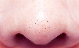 5 Cara Alami Menghilangkan Komedo di Hidung dan Lainnya