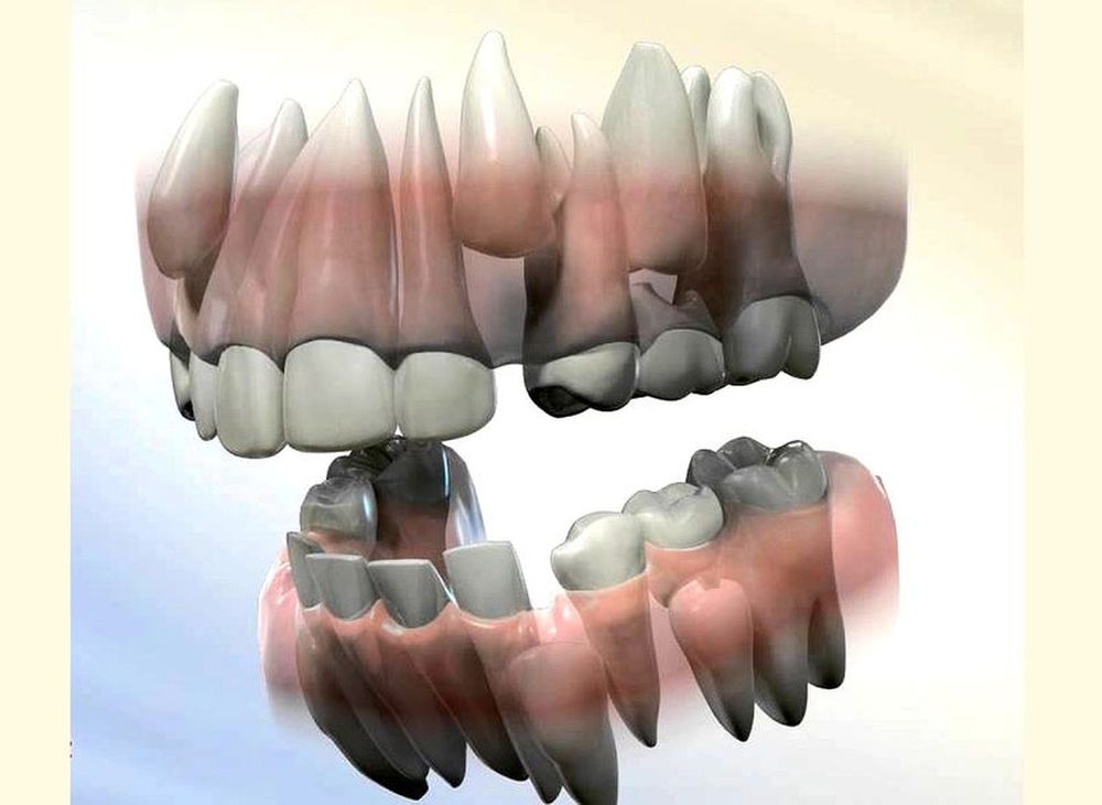 ORTHODONTICS Serial extraction of primary teeth odontobebe